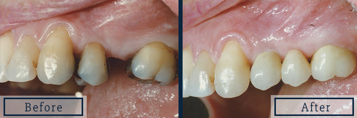 Dental Bridge Replacement